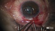 Combined Surgery in the Eye of a Patient With Weill-Marchesani Syndrome